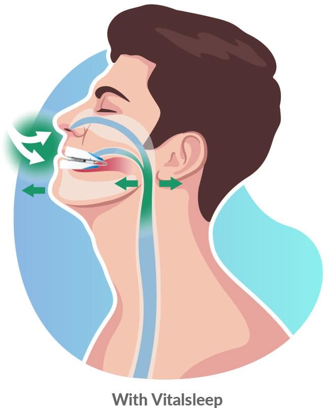 VitalSleep for snoring