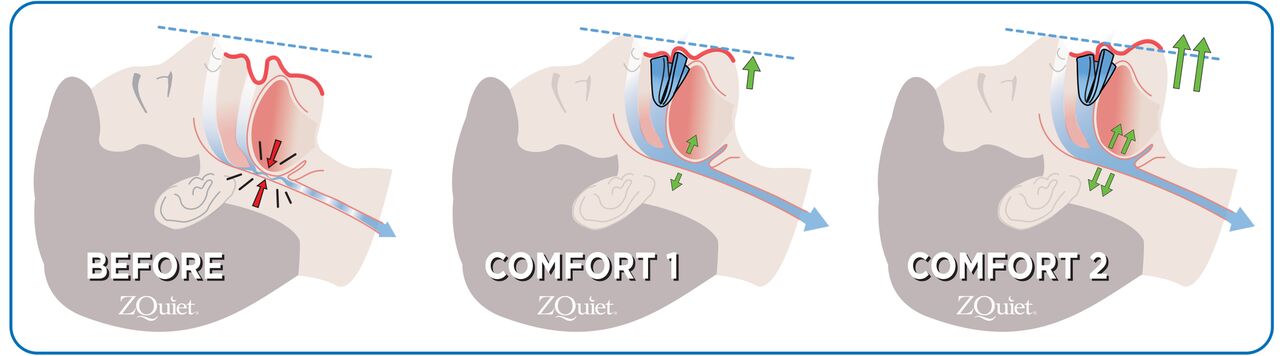 The lower jaw placement before and after using the ZQuiet devices